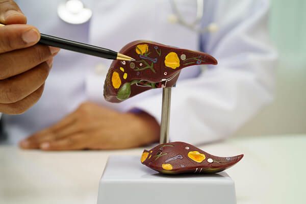 Cirrhosis and Chronic Liver Disease Support