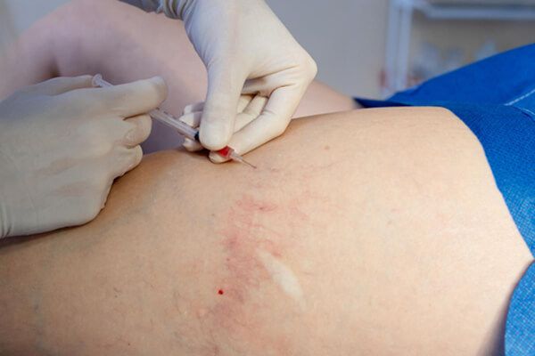 Swelling and Scar Management: 